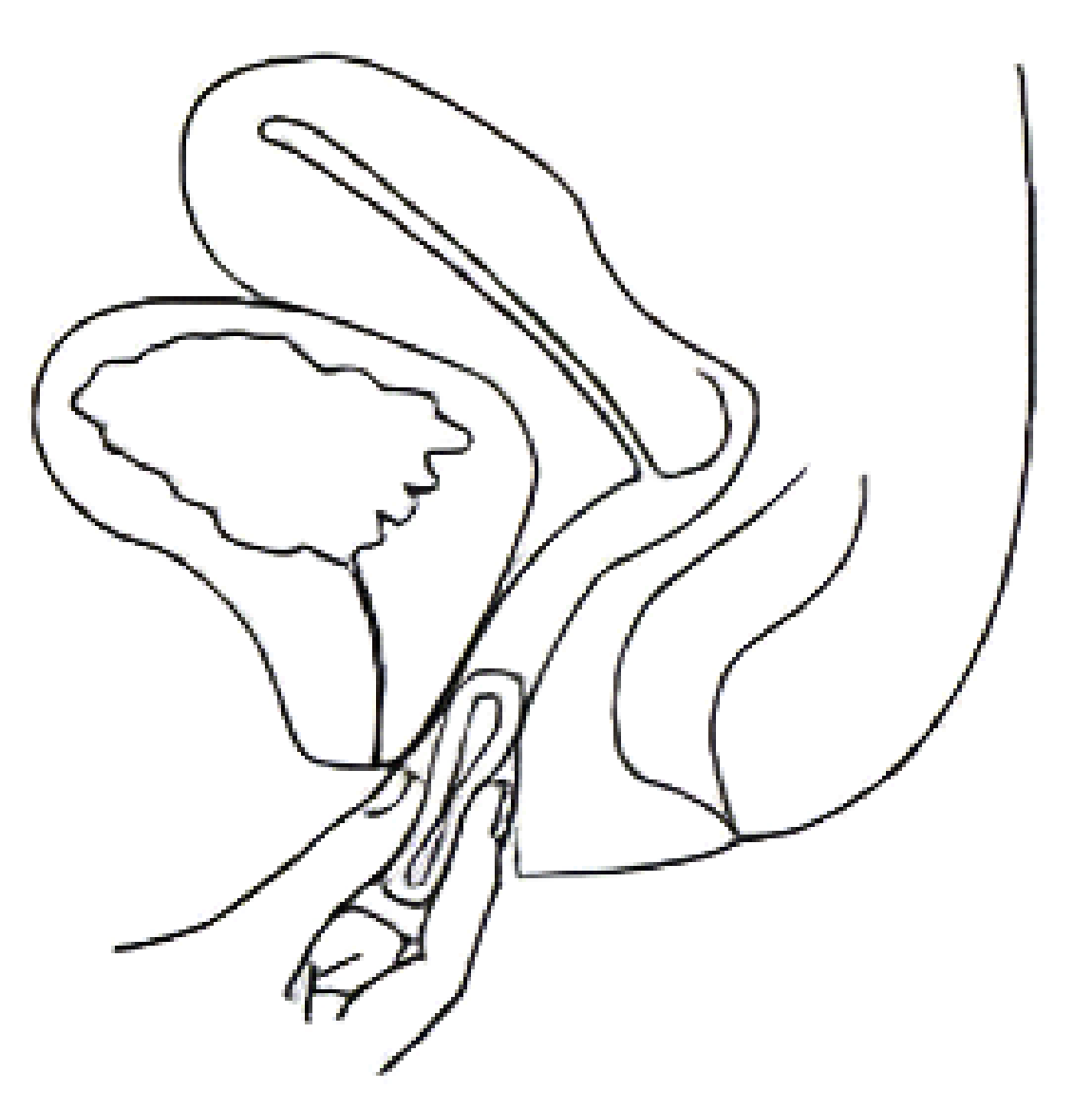 Insérer le dispositif RINGZA plié dans le vagin avec l'index