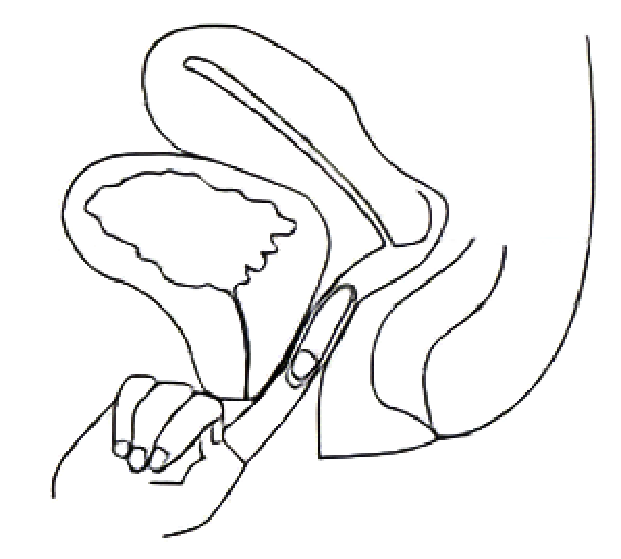 Retirer RINGZA en saisissant l'anneau avec l'index et en tirant vers l'avant